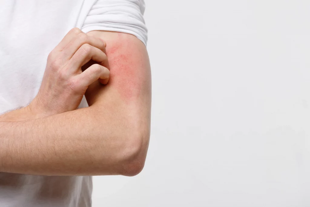 common skin rashes, heat rash, intertrigo treatment, contact dermatitis