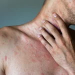 12 Basic Types of Common Skin Rashes