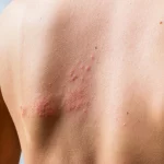 5 consejos para eliminar el acné de la espalda sin dolor