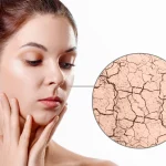 Skincare for Dry Skin in Summer - 3 Effective Tips