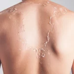 8 Comforting Tips on How to Stop Sunburn Peeling
